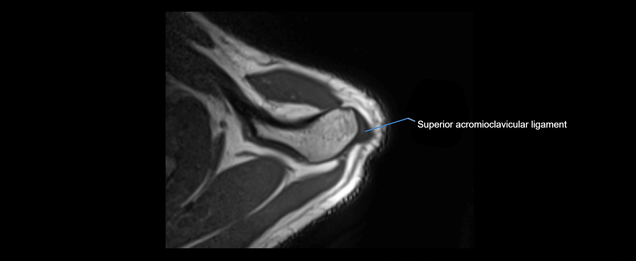 shoulder ligaments axial 3d 3t mri image-img-00005-00019.webp